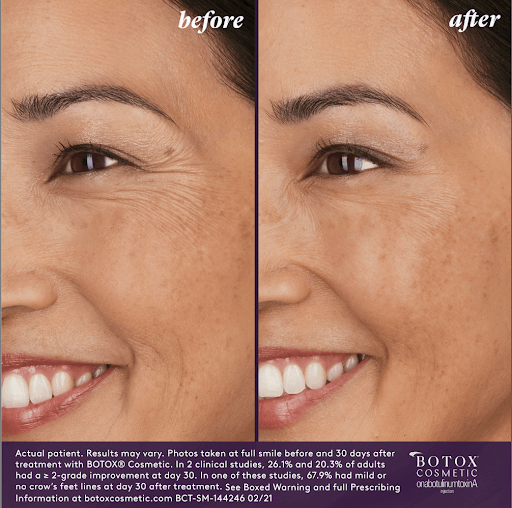 Before & After | BOTOX | Injectables | Shahla Medical Group