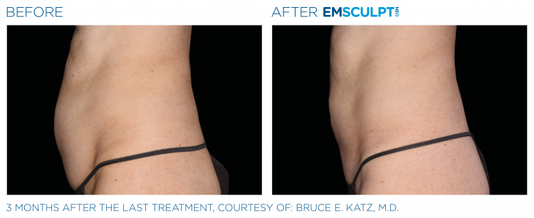 Before & After | EMSCULPT NEO | Body Contouring | Shahla Medical Group