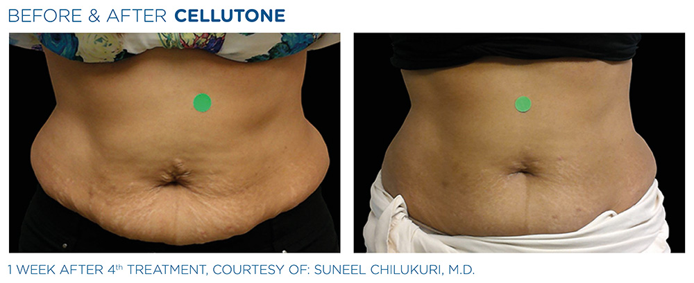 Before & After | CELLUTONE | Cellulite Reduction | Shahla Medical Group